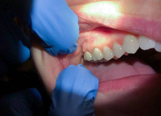 Best Dentist for Tooth Abscess  in Smithfield, NC