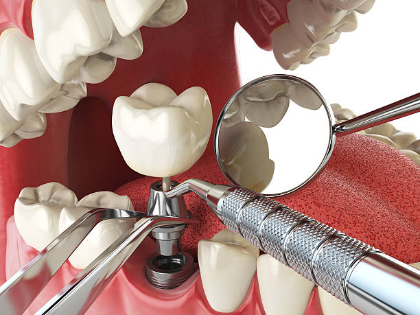 Best Chipped Tooth Repair Near Me  in Smithfield, NC